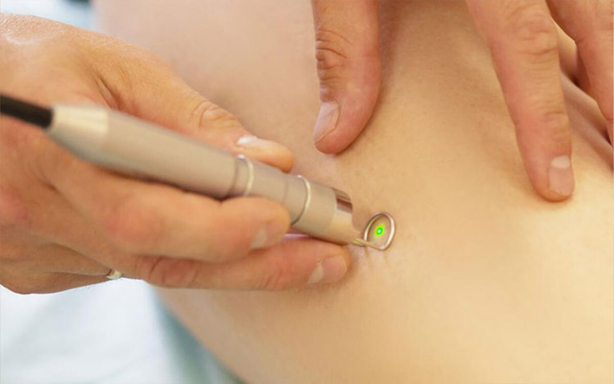 lazer ile varis tedavisi